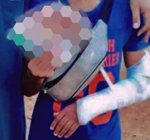 Delmas/Insécurité: Un enfant atteint d'une balle perdue à Delmas B-1